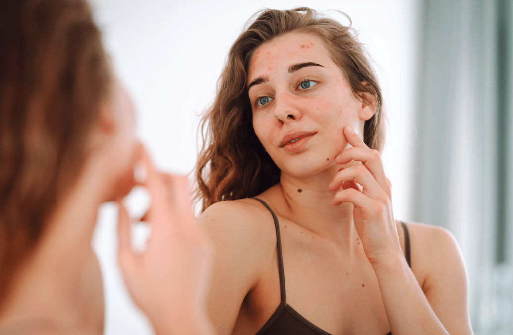 ADOLESCENCE : QUELLES CONSÉQUENCES SUR LA PEAU ?