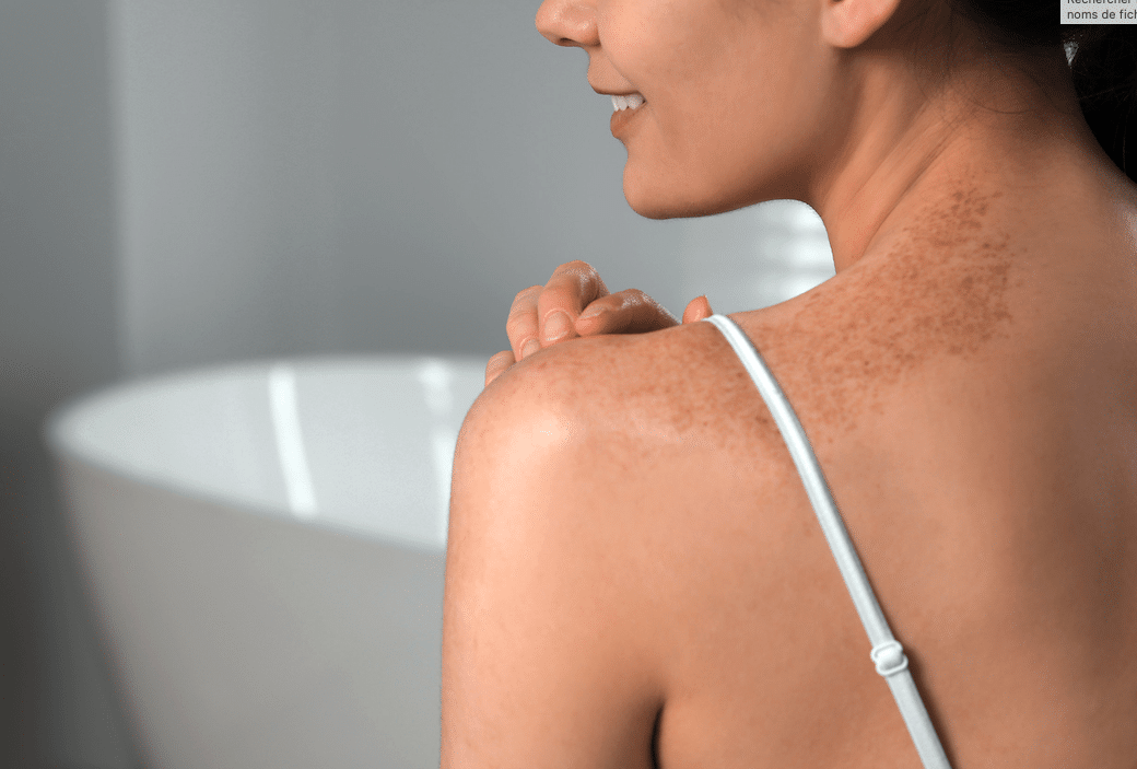 hyperpigmentation